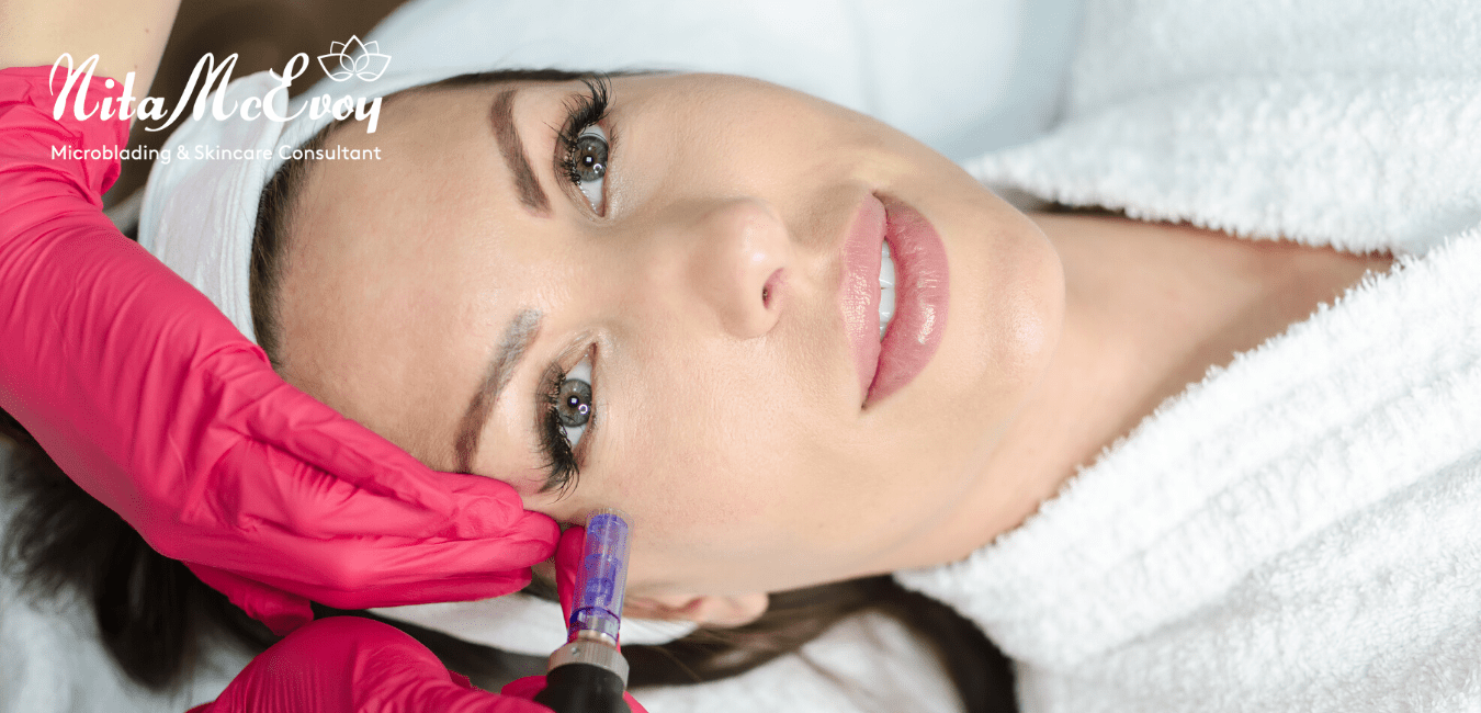Microneedling is a great way to keep you looking young!